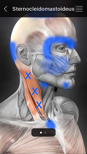 Muskel Triggerpunkte Anatomie Bildschirmfoto 13